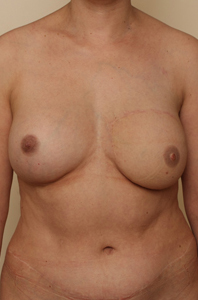 реконструкция восстановление груди молочной железы