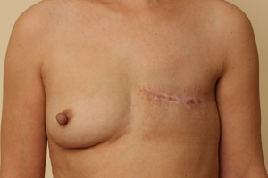 Восстановление груди свободным TRAM-лоскутом