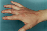 результат пересадки сустава пальца