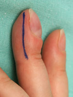 энходрома ногтевой фаланги, деформация ногтя