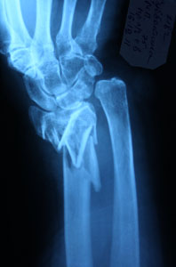 Перелом лучевой кости в «типичном месте»