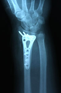 Причины переломов лучевой кости